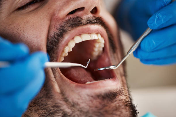 Best Emergency Wisdom Teeth Removal in Iva, SC